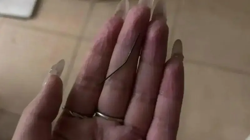 女子左臀疼1个月挤出发黑注射针头
