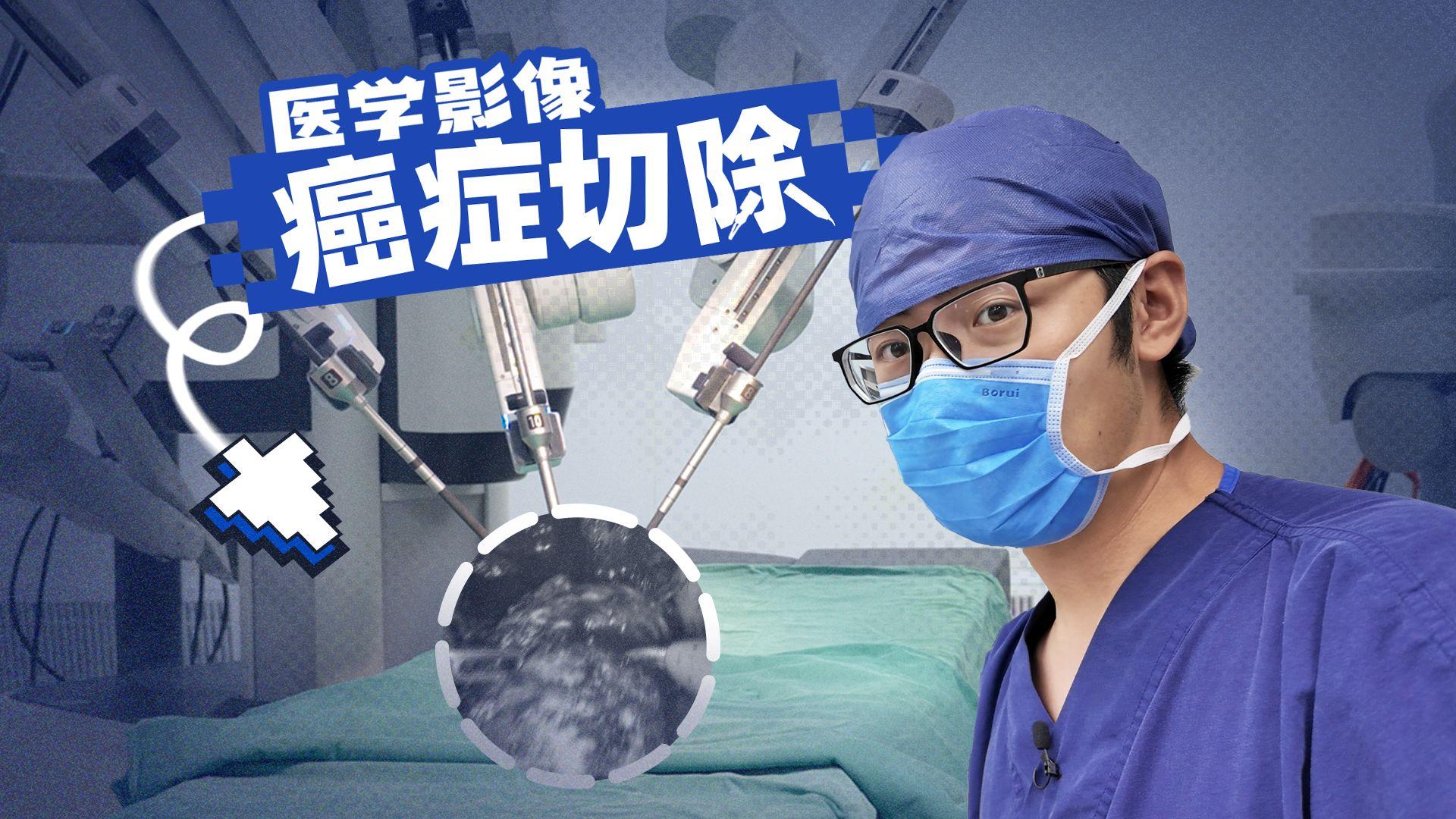 实拍!癌症是怎么被机器人切除的?